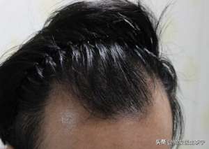 植发7个月，前额有点稀少，正常吗？北京大学国际医院李宁博士