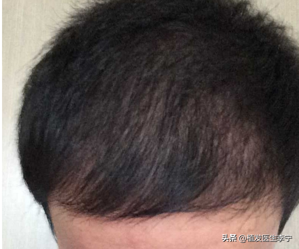 植发7个月，前额有点稀少，正常吗？北京大学国际医院李宁博士